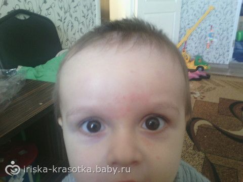 У ребёнка краснеют брови У ребёнка краснеют брови