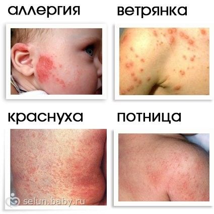 Может быть сыпь на жару у ребенка Может быть сыпь на жару у ребенка
