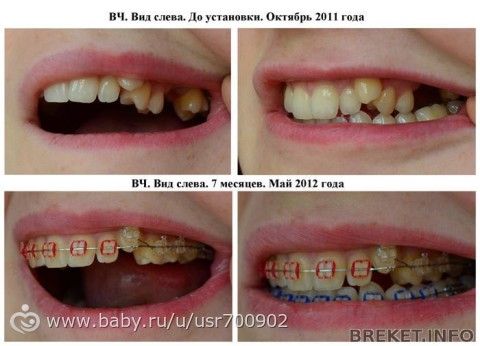 Кепки с прямым козырьком. - t Как избавиться от веснушек в домашних условиях на лице