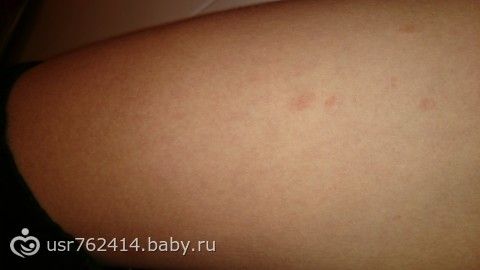 Тёмные пятна на коже бёдер Тёмные пятна на коже бёдер