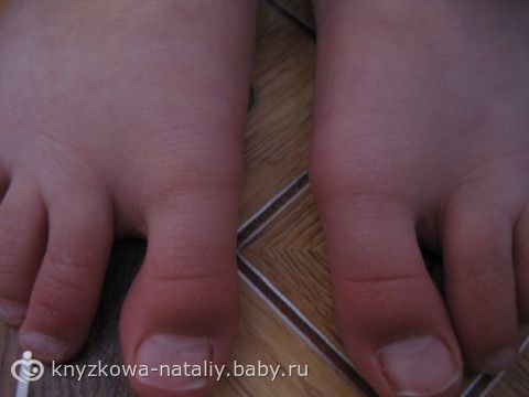 Опухла косточка ноге