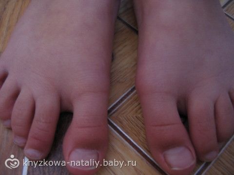 Выпирающая косточка на ноге не приговор