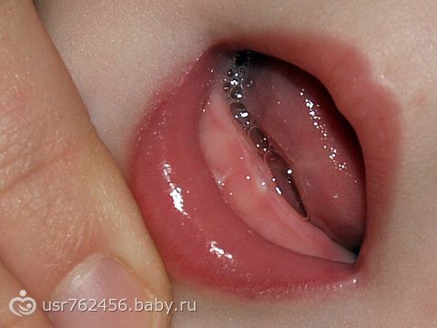 Вылезли два нижних зуба Вылезли два нижних зуба