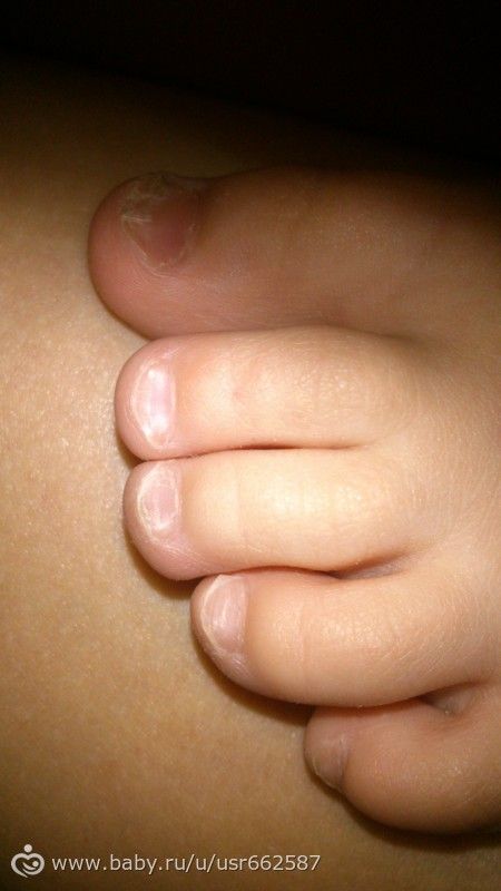 Подрезание (пластика ) уздечки языка ребенку, взрослому и подростку: как Облазит кожа после загара, что делать?. Уход за телом. Рецепты