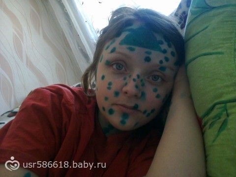 Если беременная женщина заразилась ветрянкой 52