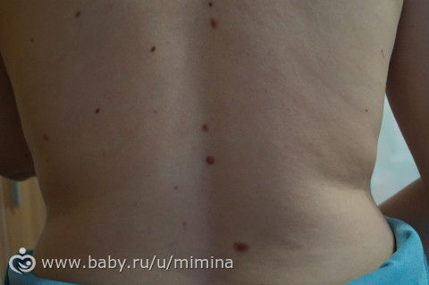 Удалить бородавки в челнах Удалить бородавки в челнах