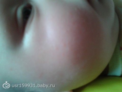 Сыпь на смесь то есть то нет Сыпь на смесь то есть то нет