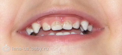 У ребенка чернеют молочные зубы что делать У ребенка чернеют молочные зубы что делать