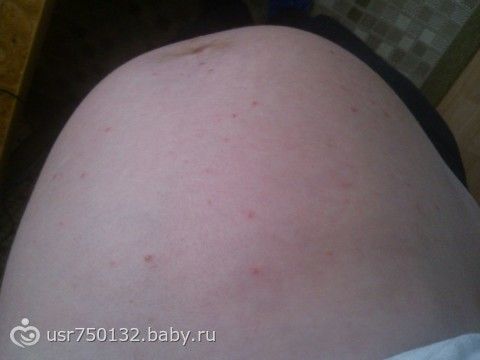 Почему вылезли прыщи при беременности Почему вылезли прыщи при беременности