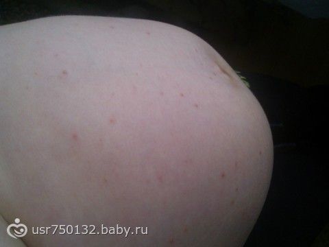 Сыпь на животе у беременных с зудом 36