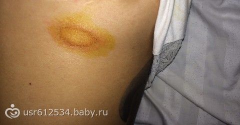 Как обрабатывать одежду при лишае Как обрабатывать одежду при лишае