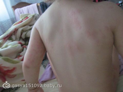 У дочки сыпь по всему телу У дочки сыпь по всему телу