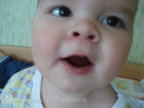 Раздражение под носом. - покраснение под носом - запись 9 Раздражение под носом. - покраснение под носом - запись 16