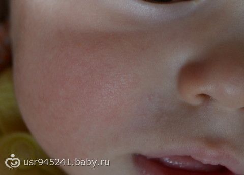Шелушение у новорожденных — как оно проявляется