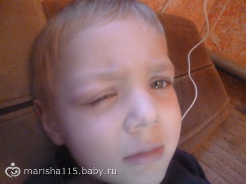 аллергия у ребенка на комариные укусы фото онлайн аллергия у ребенка на комариные укусы фото