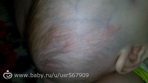 аллергия или потница?