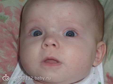 Красные точки на щеках у ребенка фото Красные точки на щеках у ребенка фото