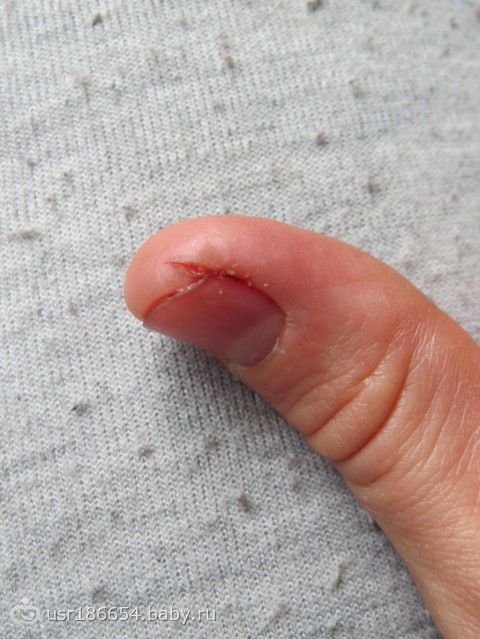 Заболевания ногтей: виды, жалобы, симптомы