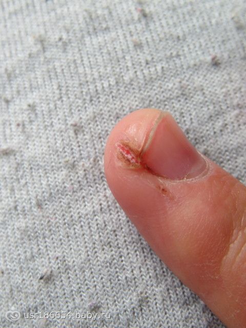 Почему трескаются ногти и кожа вокруг ногтей?