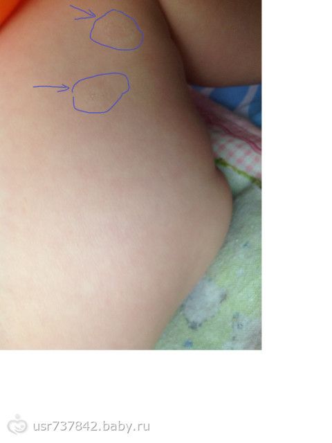 Фото лишая у детей с 1 года Фото лишая у детей с 1 года