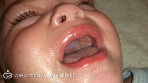срочно!нужны советы(молочница у ребенка на деснах и языке)11 мес
