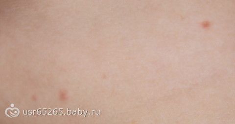 как ветрянка начинается фото
