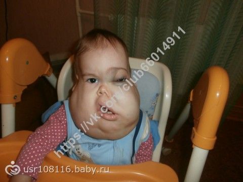 СБОР ЗАКРЫТ! СТАДНИК АРТЕМ, 1 ГОД И 10 МЕСЯЦЕВ!!! Лимфангиома дна полости рта, лица!