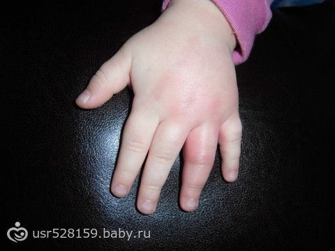 От укуса опух палец что делать 134