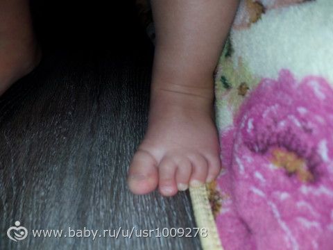Ребенок при ходьбе поджимает пальцы