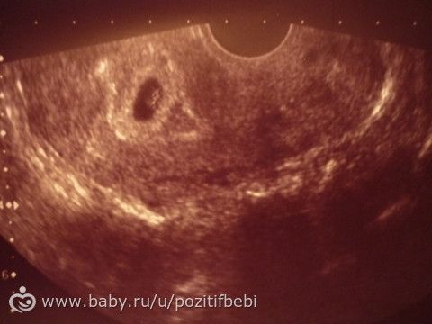 Первое УЗИ)Срок беременности (от даты последней менструации): 6 недель + 4 дня ( 7-я неделя ) Возраст плода (от даты зачатия): 4 недели + 4 дня ( 5-я неделя )